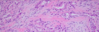 Pleomorphic Adenocarcinoma.jpg