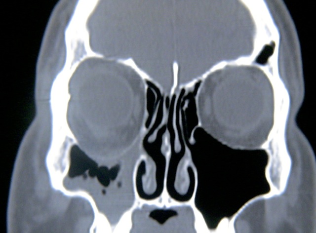 SSS CT, Coronal.JPG