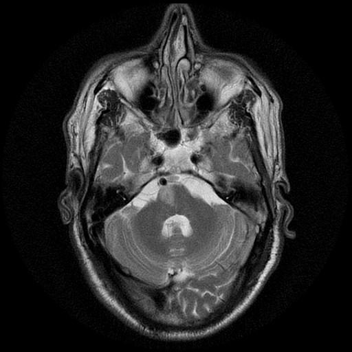 Image of magnetic resonance imaging (MRI) of the brain showing medial pontine infarction consistent with Foville syndrome.