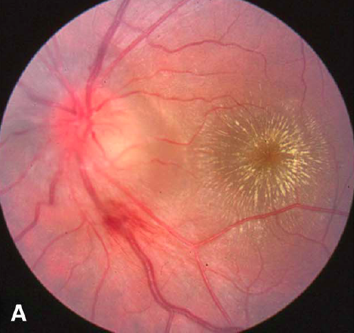 Neuroretinitis