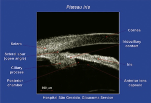 Figure 2b: Ultrasound biomicroscopy showing the structures involved in plateau iris[1]