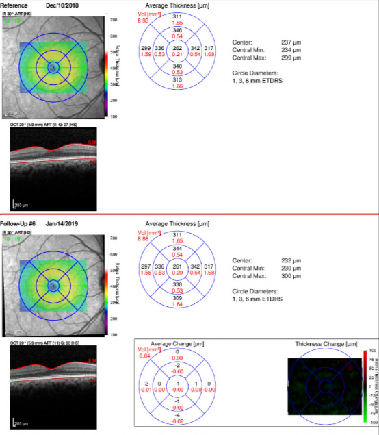 Spectralis 2 Thickness Map.PNG