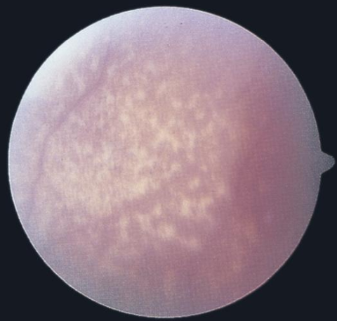 Leber congenital amaurosis, marbleized fundus type.