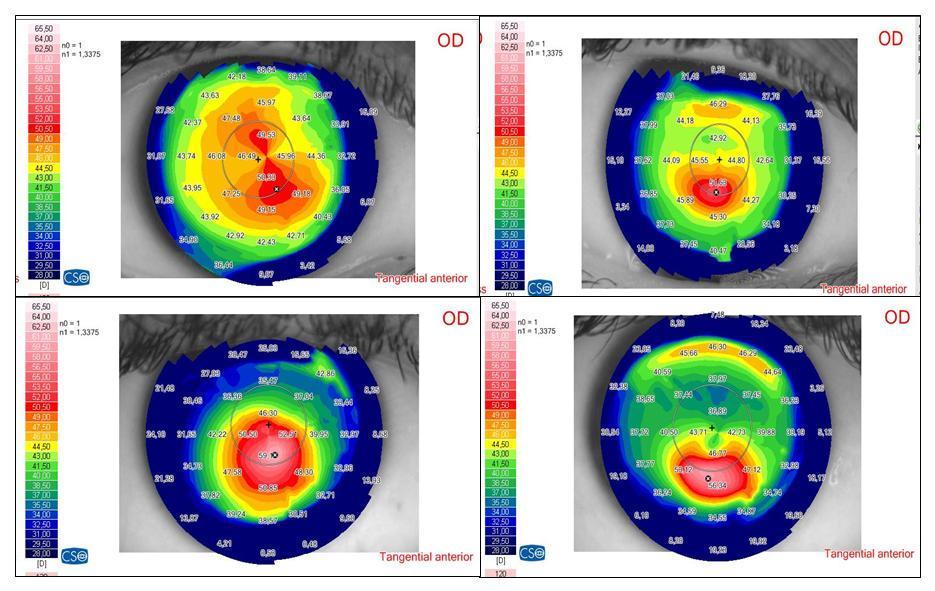 Keratoconus patterns GPrakash.jpg