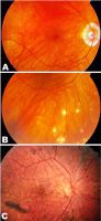 Chronic Vogt-Koyanagi-Harada (VKH) disease. Sunset glow fundus (A) and nummular chorioretinal scars (B) in a 54-year-old man with chronic VKH disease. Note that there is also peripapillary atrophy. Retinal pigment epithelial changes (C) are present in the fundus of a 36-year-old Hispanic woman with chronic VKH.