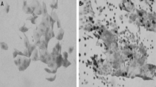 Conjunctival Impression Cytology.png