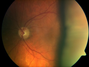 Choroidal Effusion 1.jpg