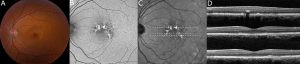 Multimodal imaging of macular pigment alterations in pentosan polysulfate maculopathy. Macular pigment clumps are visible in color fundus photography (A) and colocalize with hyperautofluorescent spots on fundus autofluorescence imaging (B) and hyperreflectant spots on near-infrared reflectance imaging (C). The lesions cast a shadow on the underlying choroid on ocular coherence tomography (D) and appear to be located in the retinal pigment epithelium. The locations of the scans in panel D correspond to the dotted lines in panel C in descending order.