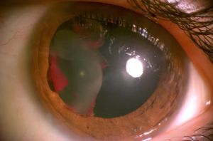 Dislocated lens in a child with acute vision loss following a physical assault in school during an altercation.