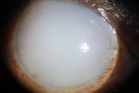 Cloudy cornea in adult – a masquerade of phacolytic glaucoma. A 75 year-old woman who in 1 weeks’ time had a total loss of vision, pain, redness, and total whitening of the right eye. Her vision in the right eye was PL + PR inaccurate and the left eye 6/12, N9 with glasses. Intraocular pressure was 60 in the right eye and 14 mm in the left eye. She was diagnosed as having cloudy cornea due to phacolytic glaucoma in the right eye. The patient was managed with I.v. mannitol, topical and systemic steroids, antiglaucoma medications to control IOP and reduce inflammation. After one week she underwent SICS+PCIOL implantation and she regained 6/9, N9 vision after s6 weeks postoperative