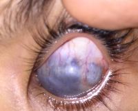 Buphthalmos in the case of late presenting congenital glaucoma.