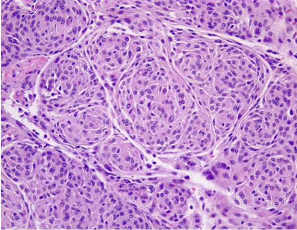 FIGURE 1: Sphenoid wing meningioma (H&E, 20x). Image depicts whorls of meningothelial cells composed of bland epithelioid type cells with eosinophilic cytoplasm arranged in a syncitium. The nuclei are ovoid with vacuoles and pseudo-inclusions.