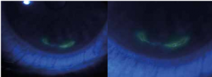 Marginal keratitis with ulceration after fluorescein staining