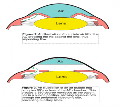 Peripheral Iridectomy and Pupillary Block.png