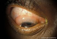 Horner-Trantas dots in vernal keratoconjunctivitis.