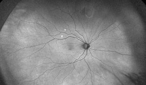 Photo creditt: Mahmoudzadeh R, Swaminathan S, Salabati M, et al. Retinal Displacement Following Rhegmatogenous Retinal Detachment Repair. Ophthalmic Surgery, Lasers and Imaging Retina. 2024 Jul 1:1-7. doi: 10.3928/23258160-20240528-01.