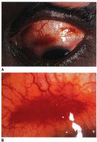 (A) Multiple Kaposi sarcoma lesions on bulbar conjunctiva. (B) High-power view of one such lesion reveals its vascular nature.