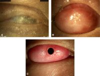 Patient 1, a 19-year-old male with Stevens–Johnson syndrome. A, Right eye, preoperative state, hand movements vision. B, Right eye 2 months after stage 1 surgery, healthy buccal mucosal graft. C, Right eye 26 months after stage 2 surgery, best-corrected vision of 20/20.