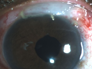 Ex-PRESS Shunt Combined with Cataract Extraction.jpg