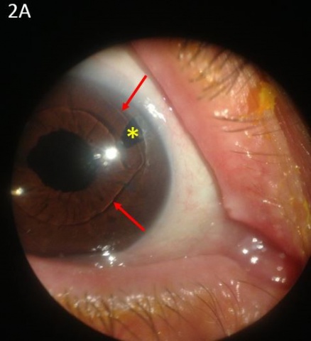 Figure 2A.Color photo showing a quiet eye with an anterior chamber intra-operative lens (red arrows) with a pre-from iridotomy (yellow asterisk). 