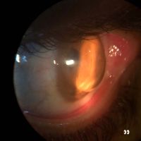 Keratoglobus. Generalized protrusion of the cornea.