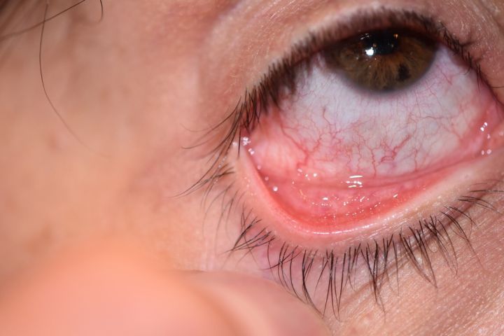 External photo demonstrating follicular conjunctivitis from MC. Courtesy of Mark A. Prendes, MD