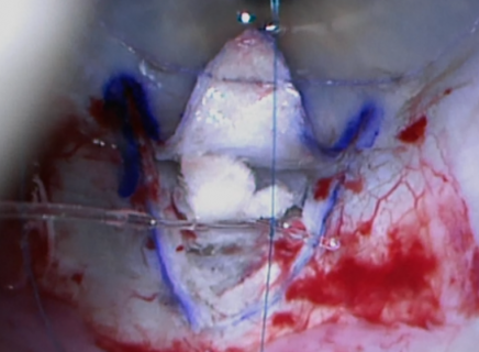 Figure 12: Tie prolene suture to the microcatheter