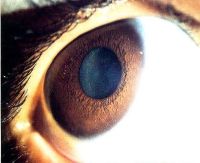 Slit-lamp photograph of a 4-year old girl (case 1) shows multiple nodules distributed diffusely on the iris surface