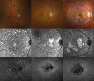 Disease spectrum in pentosan polysulfate maculopathy shown via color fundus photography (top row), near infrared reflectance imaging (middle row), and fundus autofluorescent imaging (bottom row). Severity of cases increases going from left to right