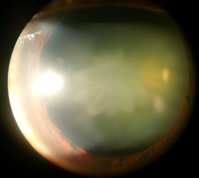 Traumatic Cataract