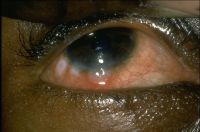 Phlyctenular conjunctivitis