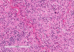 Fibrous Histiocytoma H&E 14.4x.jpg