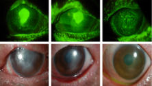 Treatment of persistent corneal epithelial defect.png