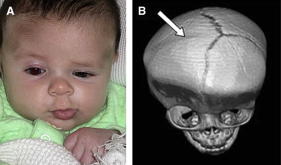 Unilateral Coronal Synostosis - EyeWiki