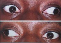 This 37-year-old woman with MG has pseudo–bilateral internuclear ophthalmoplegia. a. Left gaze. b. Right gaze