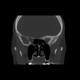 Meningioma.jpeg