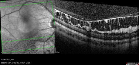 Optical coherence tomography (OCT) images of the retina of a 27-year-old female with ILMD. Note the discrete internal limiting membrane detachment and large schisis cavities sparing the fovea. This patient’s uncorrected visual acuity was 20/15 in both eyes.