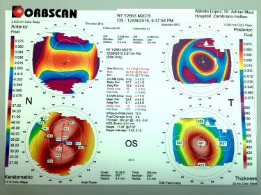 Increased area of corneal power surrounded by concentric areas of decreasing power. Asymmetric inferior-superior power. Skewing of the steepest radial axes above and below the horizontal meridian.