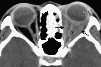 Figure 6: CT image showing enhancement of orbital fat (asterisks). Courtesy of Z.X. Ding