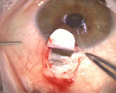 Figure 14: Tie prolene suture to apply tension to trabecular meshwork and dilate Schlemm's canal