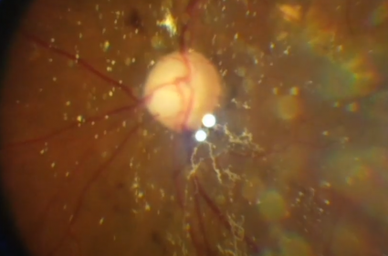 Synchysis Scintillans or Cholesterolosis Bulbi in the vitreous of an eye seen with smartphone fundus videography