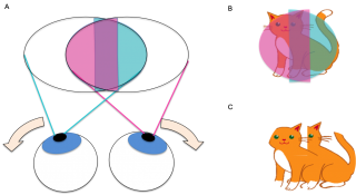 Figure 4 A) Visual field of both eyes with bitemporal hemianopia and exotropia (left eye visual field indicated in blue, right eye visual field indicated in pink, overlapping visual field indicated in purple). Note the outward deviation of both eyes. B) Visual fields of an object (cat) at the point of fixation. There is a central vertical strip that falls onto both the right and left visual fields. C) Image seen by the patient with binocular vision. The central strip of vision is duplicated, manifesting as a horizontal diplopia.