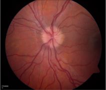 Moderate Papilledema grade 2