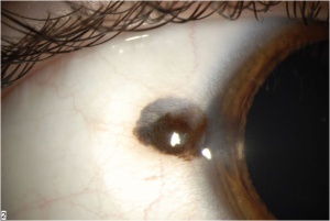 Fig. 1A - conj combined nevus clinical.jpg