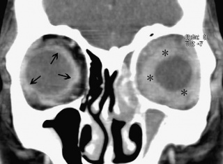 Figure 5: CT image showing thickening and blurring of left eye uveoscleral (asterisks). Courtesy of Z.X. Ding