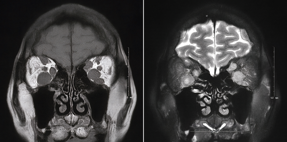 MRI EOM Mets.png