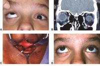 Orbital floor fracture. A, Teenaged patient following blunt trauma to the eye and orbit. Attempted gaze up and left. The left eye is unable to elevate to midline. (Note: The pupillary dilation is pharmacologic). B, Coronal CT scan of the orbit showing a small orbital floor fracture and inferior rectus muscle prolapsing into the maxillary sinus (arrow). C, Intraoperative view of a similar case showing an orbital floor defect (arrow) enlarged surgically to release and extract inferior rectus muscle. D, Two months postoperatively, the patient demonstrates resolution of upgaze limitation.