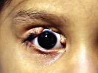 True coloboma of the upper eyelid.