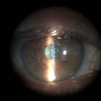 Characterized by Hyaline deposition in corneal stroma which stained with Mason Trichrome.