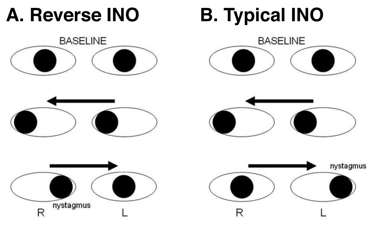 Internuclear Ophthalmoplegia Eyewiki